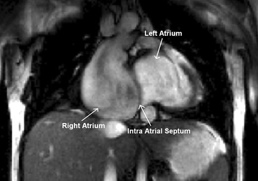 Cardiac magnetic resonance imaging following ablation. The right atrium is severely dilated with slow flow, the left atrium moderately dilated, and the right ventricle rudimentary. The atrial septal defect is not visible on the magnetic resonance imaging.