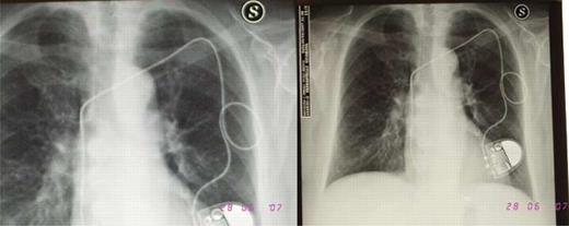 Patient's chest X-ray.