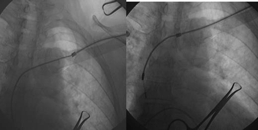Fluoroscopic images of laser lead extraction.