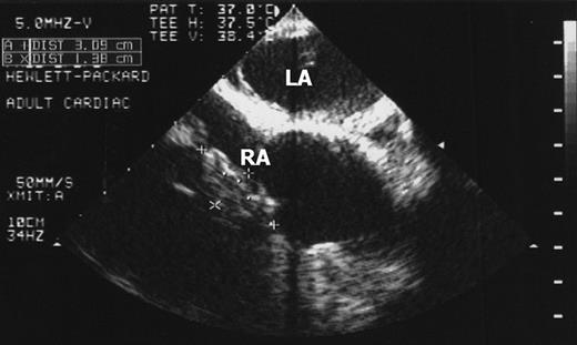 Illustration of a great vegetation connected with leads in the right atrium (RA) before the lead removal procedure: TEE picture (vegetation marked on the pictures).