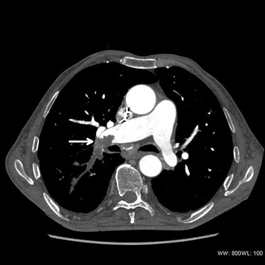 Computed tomography picture: defragmented vegetation obstructing lobular and segmental branches of the right pulmonary artery (arrow).