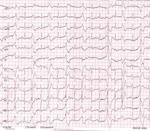 Typical ECG by exercise test in a heterozygous RyR2 mutation carrier. ECG shows multifocal ventricular premature beats with left bundle branch block configuration in bigeminy, at a heart rate of 120 beats/min.
