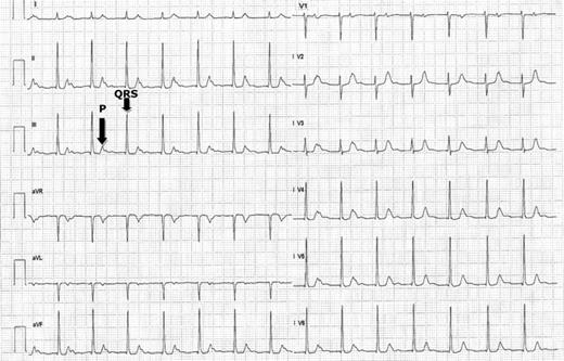 Twelve-lead ECG at rest showing first-degree AV block with a PR interval of 480 ms. The QRS complex following the corresponding P-wave is shown by the black arrows.