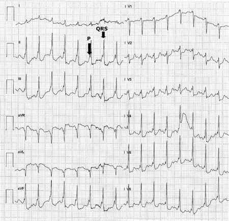 Twelve-lead ECG of the exercise test showing constant PR interval with gradual shortening of the RR interval. The QRS complex following the corresponding P-wave is shown by the black arrows.