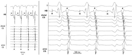 Left: intracardiac recordings showing the change from the first tachycardia to the other one, with an increase in VA interval and in tachycardia cycle length (see text). Right: intracardiac recordings during the tachycardia utilizing the left superior accessory pathways showing nearly simultaneous retrograde activation at the His bundle lead and at the distal coronary sinus. Of note that distal and proximal coronary sinus were also almost synchroneously activated, which would have not been the case in presence of anteroseptal or left posterosuperior accessory pathways. CS, coronary sinus; HB, His bundle lead; H, H bundle potential; A, retrograde atrial depolarisation.