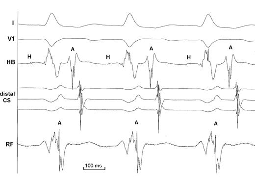 Intracardiac recordings during the second radio-frequency (RF) procedure showing earliest retrograde atrial activation at the RF catheter located at the superior aspect of the mitral annulus. Coronary sinus activation was more delayed during this procedure because coronary sinus lead was not so distally positioned (see Figure 3 ). Of note that VA interval at the successful ablation site is almost virtual, indicating that the length of the left superior by-pass tract is probably short despite the assumed wide fibrous area separating atrial and ventricular myocardium at this site. Same abbreviations as in Figure 1 .