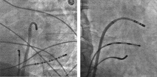 Left (left) and right (right) anterior fluoroscopic views of the successful RF ablation site at the superior aspect of the mitral annulus after transseptal catheterisation. Other catheters were positioned at the His bundle area and at the coronary sinus.
