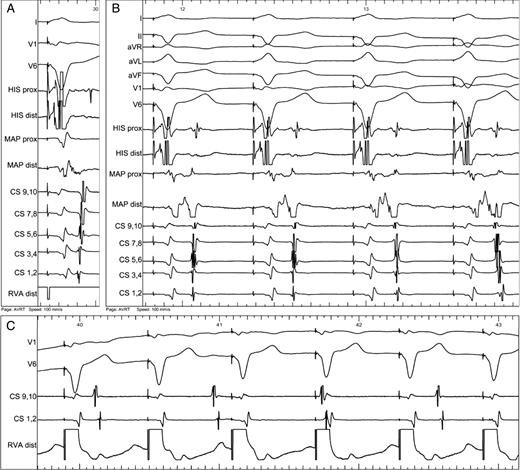( A ) Activation sequence during right ventricular pacing. Short ventriculoatrial interval showing activation of the left atrium by retrogradely conducting accessory pathway at lateral part of mitral annulus (first activation in distal CS 1,2). Almost merged ventricular and atrial signals are recorded from the ablation catheter (MAP). ( B ) During radiofrequency energy application, gradual change of the activation sequence was observed from prolongation of the VA interval (first three beats) to complete change of activation sequence (last beat). Note that the timing of atrial activation in the ablation catheter was still earlier than in the proximal CS (CS 9,10). ( C ) Complete ventriculoatrial dissociation during right ventricular apical pacing at the end of procedure.