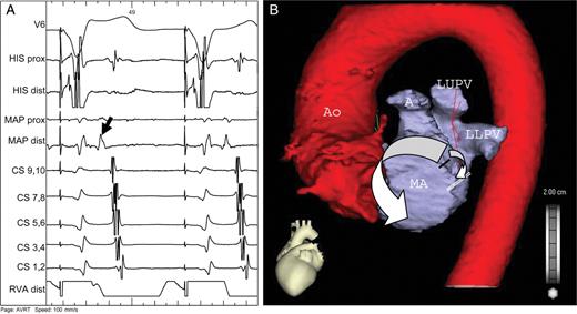 ( A ) Ablation catheter (MAP) is positioned in the left coronary cusp. Note the early activation of anteroseptal region of the left atrium (black arrow) during retrograde conduction. ( B ) CT scan of the left atrium and aorta with schematic drawing of retrograde activation of the left atrium (white arrows). The impulse propagates via the accessory pathway (black line) downwards to the line of mitral isthmus block (double white line) and simultaneously upwards, passing through the left atrial roof and continuing along the interatrial septum and right pulmonary veins to the low posteroseptal region, thus mimicking concentric retrograde activation (see also A ). Ao—aorta, A—auricle, LUPV—left upper pulmonary vein, LLPV—left lower pulmonary vein, MA—mitral annulus.