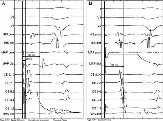 Proof of mitral isthmus block. ( A ) Pacing from the distal coronary sinus (CS 1,2) placed inferior to the mitral isthmus line of block leads to double spike signal on the line of mitral isthmus recorded at the ablation catheter (MAP), which is positioned endocardially on the line of block. The first spike is 20 ms from the stimulus, whereas the second is delayed by 120 ms—the time that the impulse needs to encircle left atrium in the clockwise direction (see also Figure 2 B ). ( B ) Similar pacing manoeuvre from the ablation catheter, which is now placed superior to the line of block. The impulse needs 134 ms to propagate in the counterclockwise direction around the mitral annulus to reach the distal CS. Note additionally the concordant septal activation indicated by His recording.
