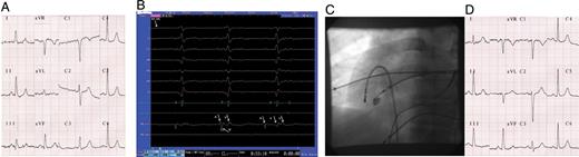 Patient 1 baseline ECG ( A ), intracardiac recordings during successful RF application ( B ), left anterior oblique (LAO) radioscopic projection of the ablation catheter position during successful RF application ( C ), and post-ablation ECG ( D ). ‘RF-on’, start of the RF application; A, local atrial electrogram; V, local ventricular electrogram; V′, far-field ventricular electrogram.
