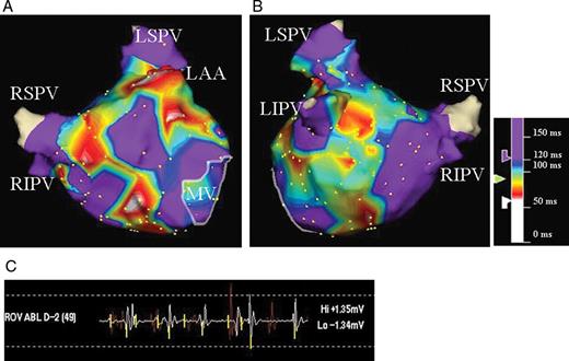 CFAE map of the LA in anteroposterior ( A ) and posteroanterior ( B ) views. Atrial electrograms during AF were analysed using an automated CFAE algorithm. The average time duration between consecutive deflections in a local electrogram over 5 s at each site was calculated; the colour-coded value for each site is displayed on the three-dimensional LA geometry. Areas coloured white and red represent areas with very rapid and/or fractionated local electrograms. Areas with mean cycle length >120 ms are coloured purple. CFAE, complex fractionated atrial electrogram; AF, atrial fibrillation; LA, left atrium; LSPV, left superior pulmonary vein; LIPV, left inferior pulmonary vein; RSPV, right superior pulmonary vein; RIPV, right inferior pulmonary vein; LAA, left atrial appendage; MV, mitral valve.