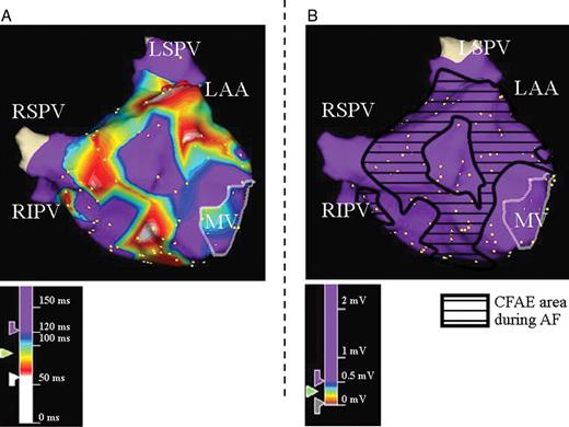 Example of electrogram analysis during SR at CFAE and non-CFAE sites during AF. Three-dimensional electroanatomical maps of the LA in anteroposterior views during AF ( A ) and SR ( B ) are shown. ( A ) CFAE map recorded during AF and ( B ) voltage map recorded during SR. The area surrounded by the black line in B indicates the CFAE sites that correspond to A . SR, sinus rhythm; other abbreviations as in Figure 1 .