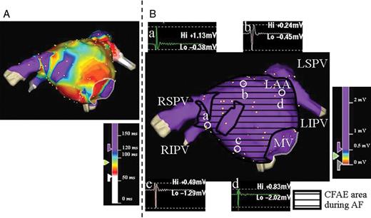 Three-dimensional electroanatomical maps of the LA in anteroposterior views during AF ( A ) and SR ( B ) in a patient from the term group. ( A ) CFAE map of the LA. ( B ) Voltage map during SR with sample bipolar atrial electrograms. The area surrounded by the black line in B indicates the CFAE sites that correspond to A . The amplitudes and morphologies of the electrograms at sites a, b, c, and d are thought to be normal. There was no low-voltage electrogram in the LA during SR in this case. SR, sinus rhythm; other abbreviations as in Figure 1 .