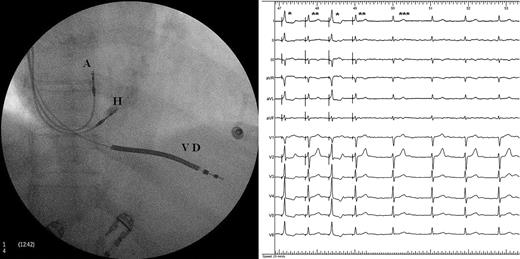 Posteroanterior radiograph of a defibrillator with His-bundle pacing resynchronization. Left Panel : A, lead in the right atrial appendage; H, lead positioned on the His bundle; VD, lead on the right ventricular apex. Right Panel : ECG in atrial fibrillation. QRS complexes marked with a single asterisk are fusion complexes, double asterisks represent pure His stimulations, and triple asterisks represent native QRS.