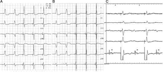 ( A ) ECG in sinus rhythm with left branch block, treated with His-bundle pacing pacemaker in DDD mode. Disappearance of left block with latency and QRS normalization can be observed. ( B ) Same ECG as in ( A ), with 60-ms activation following the His-bundle pacing, right ventricular pacing; the pacing spike is seen to fall onto the R-wave. ( C ) Complete infra-Hisian block, treated with His-bundle pacing pacemaker in VVI mode; the induced QRS are of normal morphology and duration and show latency by pure His-bundle capture.