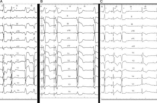 ( A ) ECG showing sinus rhythm and left branch block (triple asterisks). A single asterisk marks the QRS resulting from the fusion of His-bundle capture and adjacent myocardial capture, double asterisks marks the QRS of pure His-bundle capture, which is the central left bundle-branch block. ( B ) ECG showing left bundle-branch block sinus rhythm (double asterisks). The QRS marked with a single asterisk is caused by His-bundle pacing with pure His-bundle capture and has the same morphology and duration as native QRS. This is a peripheral left branch block. ( C ) ECG showing sinus rhythm, first-degree AV block, and right bundle-branch block (triple asterisks). The QRS complex marked with a single asterisk is fused, making the right bundle-branch block disappear without QRS normalization. The QRS marked with double asterisks is a pure His-bundle capture, showing latency and native right bundle-branch block. This is a peripheral right bundle-branch block.