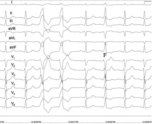 Patient 2. Twelve-lead electrocardiogram showing a pair of ventricular premature beats (VPBs) and a fusion beat (F). The frontal QRS axis of the first ventricular premature beat shows right axis deviation and a QS pattern in I. In contrast, the QRS complex of the second ventricular premature beat is the mirror-shape of the first ventricular premature beat in lead I showing a normal frontal QRS axis of 60° and a R-R′ pattern, indicating that the electrical impulse exits from the interventricular septum to the left side of the septum in the first ventricular premature beat and vice versa in the second ventricular premature beat. Another explanation for the differences in the QRS complex between the first and the second ventricular premature beat is that the second ventricular premature beat is a fusion beat most apparent in V 5 and V 6 . Notably, there is complete concordance between the QRS vector of the sinus beats and the QRS vector of the second ventricular premature beat in all 12 electrocardiogram leads.