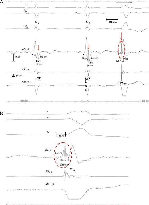 Patient 7. ( A ) Intracardiac electrograms demonstrating the local potentials, LVP and LVP vpb . Shown are: standard electrocardiogram lead I, V 1 , and V 6 . A high amplified bipolar electrogram is recorded close to the site of origin of the VPB (ABL d), together with a unipolar electrogram (ABL uni) and a bipolar electrogram from the proximal pairs of the ablation catheter (ABL p). The LVP potentials (red arrows) are recorded 75 ms after the earliest start of the QRS complexes of S −1 (black line in V 1 ). The LVP ampl is 2.00 and 0.93 mV, and the LVP dur is 56 and 48 ms in S −1 and S −2 , respectively. ( B ) Magnification of the LVP vpb (red circle). The amplitude of the LVP vpb is 2.33 mV, the duration 65 ms, and it is preceded by a slow and low-amplitude potential not present in the LVP of S −1 and S −2 . The LVP vpb starts 42 ms prior to the earliest start of the QRS complex of the VPB (black lines in V6), and the ABL uni shows no LVP vpb , due to far-field sensing of the V potential and a QS pattern indicating optimal ablation site. For further discussion, see text.