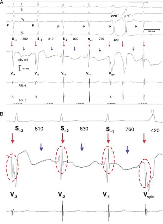 Patient 8. ( A ) Ventricular parasystole with concealed fusion and intermittent 2:1 exit block. The electrocardiogram shows apparently four sinus beats preceding a pair of ventricular premature beats. The R-wave in I and V 2 shows a higher R-wave in S −3 compared with the R-wave of S −1 , S −2 , and S −4 . The intracardiac electrograms and especially ABL uni show that only S −1 and S −2 and the beat after the pair of ventricular premature beats are sinus beats, with the LVP recorded at the end of the local V potential, whereas S −3 is a fusion beat (F), preceded by the LVP vpb (red arrows), as is S −4, but to a lesser degree than S −3 . Notably, the ventricular premature beats and fusion beatshow the LVP vpb with reversed polarity compared with the LVP of the sinus beats. In addition, the second ventricular premature beat of the pair may also be a fusion beat (F?) resulting from decremental AV conduction of the sinus impulse, i.e. the P-wave (P*), preceding the first ventricular premature beat due to concealed retrograde conduction into the AV junction of the first ventricular premature beat. Alternatively, a different exit from the ectopic pacemaker may explain the difference in the QRS complex between the two. Notably, the PR interval of the sinus beat after the pair of ventricular premature beats is prolonged compared with the PR interval of the two sinus beats before the pair of ventricular premature beats. This is probably due to concealed retrograde conduction into the AV junction of the ventricular parasystolic focus located in the high interventricular septum. The R-R interval between the pair of ventricular premature beats is 420 ms (the least common denominator); the R-R interval between S −4 and S −3 is 800 ms (400 × 2); the R-R interval between S −3 and S −2 is 810 ms (405 × 2); and the R-R interval between S −2 and S −1 is 760 ms (360 × 2). Finally, the S −1 − VPB is 760 ms (360 × 2). This is consistent with ventricular parasystole with intermittent 2:1 exit block (blue arrows). Since the intracardiac electrograms do not show local potentials associated with the blocked beats, the LVP vpb does not represent pacemaker activity, but rather slow conduction of the impulse after exiting the protected zone. ( B ) Magnification of S −3 , S −2 , S −1 , and the VPB with the LVP and the LVP vpb highlighted by red circles. Abbreviations are as in Figure 2 .