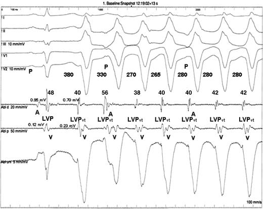 Patient 19. Non-sustained ventricular tachycardia from the right ventricular outflow tract. The coupling interval of S −1 with the first beat of the ventricular tachycardia is 380 ms, and the ventricular tachycardia cycle length stabilizes at cycle length 280 ms. The LVP vt duration is rather constant between 38 and 42 ms except for the second beat of the ventricular tachycardia where it is 56 ms. This is probably due to fusion of the LVP vt and the A potential of the sinus beat. The amplitude of the LVP in the distal pairs of the ablation catheter of S −1 is 0.95 and 0.70 mV in the LVP vt compared with 0.12 and 0.23 mV in the proximal pairs. The electrode spacing is 2 mm between the bipoles, with 5 mm spacing between the distal and the proximal pairs. For further discussion refer to the text.