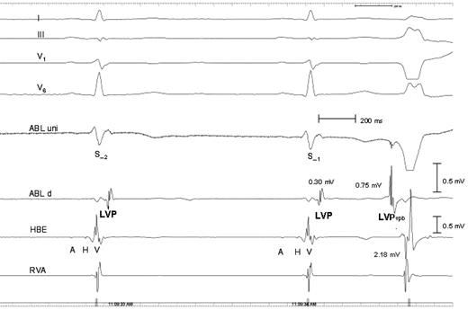 Patient 4. Intracardiac electrograms demonstrating that the LVP potential is a local potential recorded in electrograms close to the ectopic focus only. Recordings are the same as in previous figures. In addition, a His bundle electrogram is recorded 2–3 cm away from the ablation catheter located at the site of origin of the ventricular premature beats, together with a right ventricular electrogram recorded at the right ventricular apex (RVA), 5–6 cm away from ABL uni and ABL d. No LVP and LVP VPB potentials are seen in His bundle electrogram, and the amplitude of the LVP vpb is 0.75 mV compared with 2.18 mV of the V potential in the His bundle electrogram. A is atrial electrogram in the His bundle electrogram, and H is the His bundle potential.