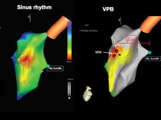 Patient 9. Electroanatomical mapping (Carto map): left lateral view looking on the interventricular septum. (To the left) Activation map during sinus rhythm. The earliest electrical activation of the QRS complex starts at the high interventricular septum (purple colour), resulting from activation of the septum via the left anterior fascicle. (To the right) Activation map of the ventricular premature beat showing the location of the ectopic pacemaker in the high interventricular septum (brown filled circles) 3 cm anterior and 1–2 cm cranial to the His bundle (green filled circle). The earliest septal activation of the ventricular premature beats starts anteriorly and cranially, compared with the earliest activation of the sinus beat. The activation spreads similarly to the sinus beat downwards the septum.
