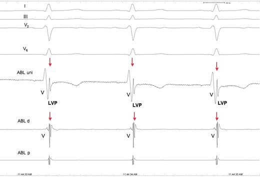 Patient 8. Intracardiac electrograms recorded after successful catheter radiofrequency ablation. The local voltage potential is still present. For comparison, see Figure 3 .