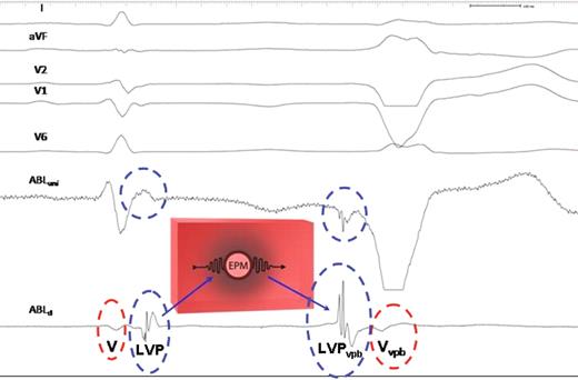 Schematic illustration of the possible explanation for the recording of local potentials. (To the left) Sinus beat. An ectopic pacemaker (EPM) is located in the high interventricular septum, surrounded by an inexcitable barrier of conduction impairment (grey shaded area). The electrical impulse of the sinus beat giving rise to the LVP (blue circle) is recorded at the end of the QRS complex, 60 ms after the onset of the local V potential (red circle), conducts slowly into the zone of depressed conductivity, and is blocked, thereby protecting the ectopic pacemaker by entrance block. (To the right) Ventricular premature beats. When the ectopic pacemaker fires, the impulse is conducted in the opposite direction through the zone of impaired conduction. This leads to the inversion of the polarity of the LVP vpb compared with the LVP of the sinus beat and the LVP vpb now precedes the local V vpb with 45 ms.