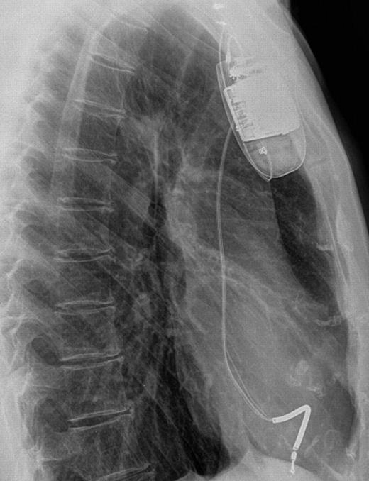 Lateral chest radiograph Case 1.