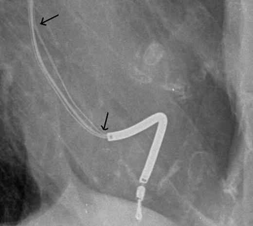 Lateral chest radiograph Case 1—detail.