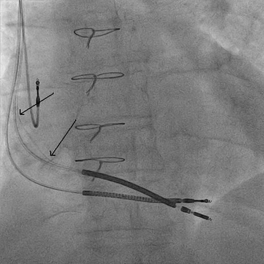 Posteroanterior chest radiograph Case 2 after new lead implanted.