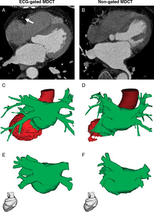  Segmentation of LA from MDCT data sets. Segmentation of ECG-gated ( A , C , and E ) and non-gated ( B , D , and F ) MDCT data sets was performed using the CartoMerge™ Image Integration Module. Shown are representative axial images of MDCT data sets ( A and B ), the corresponding semi-automatic segmentation results ( C and D ), and the final reconstruction of the LA after manual editing ( E and F ). Note that ECG-gated MDCT ( A ) clearly depicted the right coronary artery (marked with an arrow), whereas the right coronary artery was severely blurred on non-gated MDCT due to motion artefacts ( B ). 