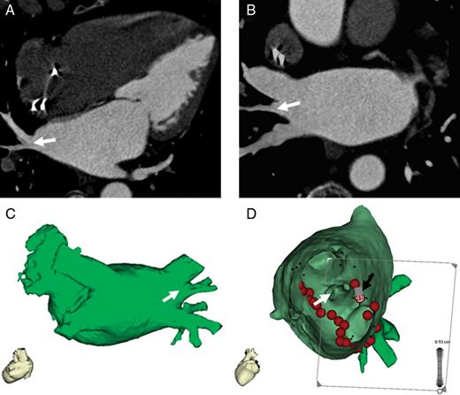  Reconstruction of the LA from non-gated MDCT with excellent image quality. Pulmonary vein isolation was performed using LA reconstruction from non-gated MDCT (75-year-old woman with paroxysmal AF and implanted pacemaker). Shown are a representative axial image ( A ), paraaxial image ( B ), corresponding LA reconstruction ( C ), and the fused electroanatomic map ( D , view from inside of the LA to right PVs). The right middle PV (white arrow) is clearly visualized. Tags on fused electroanatomic map indicate sites of radiofrequency current delivery. The black arrow indicates the position of the ablation catheter performing an ablation at the posterior part of the ridge between the right inferior PV and the middle PV. 