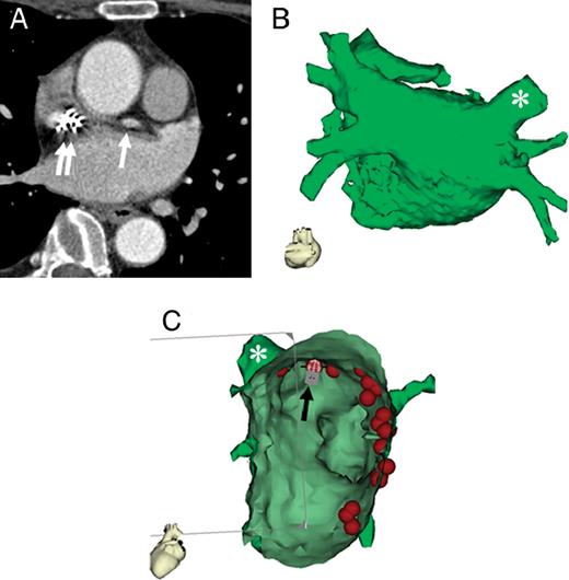  Reconstruction of the LA from non-gated MDCT with moderate image quality. A 59-year-old woman with moderate image quality of non-gated MDCT ( A ) due to motion artefacts from pronounced atrial contraction (white arrow) and streak artefacts from pacemaker leads (white double arrow). Despite moderate irregularities of the endocardial surface, LA reconstruction ( B ) had sufficient image quality for integrated EAM ( C , view from inside of the LA to right PVs). Tags on fused electroanatomic map indicate sites of radiofrequency current delivery. The black arrow indicates the position of the ablation catheter performing ablation at the superior part of the ostium of right superior PV (marked with asterisk). 