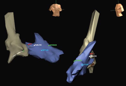 Illustration of anatomical reconstruction of the right ventricle (shown here with the right atrium) and tagging of pacing sites (para-Hissian, mid-septal, and anterior).