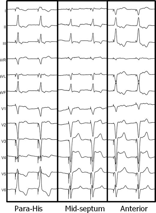 Example of QRS morphology from different pacing sites. Note greater negativity in lead I when pacing from the anterior free wall compared with from the mid-septum.