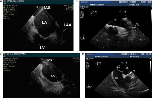 Left atrial appendage (arrows) visualization by using ICE (A) and micro-TEE (B) prior to transseptal puncture. Visualization of tenting of the interatrial septum by using ICE (C) and micro-TEE (D).