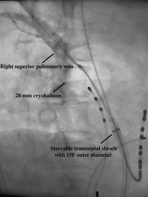Excellent occlusion of right superior pulmonary vein with 28 mm cryoballoon with full retention of contrast medium distally; taken at right anterior oblique 40° projection.