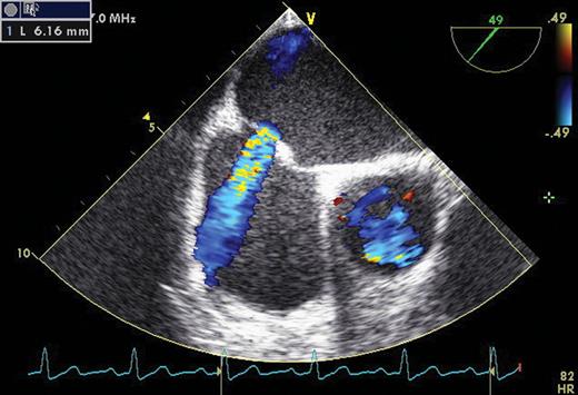 Persistent iatrogenic atrial septal defect with left-to-right shunt in a patient 9 months after a cryoballoon procedure as shown by transoesophageal echocardiography.