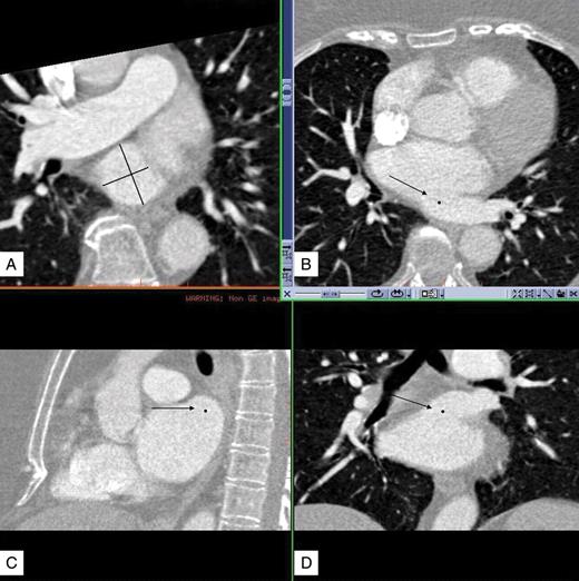 Reconstructed images of the multidetector computed tomography were transferred to a PACS workstation with 3D capabilities (Centricity, AW Suite, General Electric) to create multiplanar reformations in the axial (B), sagittal (C), and coronal (D) orientations. Arrows show the ostium of an LCO with LCT. Dots represent the plane of the ostium on each orientation. On a reformatted adaptive plane (A) we determined the strictly perpendicular plane to the ostium and measured the minimal and maximal ostial diameter. This procedure was performed for each pulmonary vein ostium.