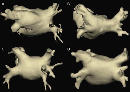 Three-dimensional reconstructions of the left atrium and pulmonary veins in a posterior view, showing different anatomical variants found in our study. (A) Left common ostium with a long common trunk. (B) Right common ostium. (C) Right middle pulmonary vein, with an early-branching pattern. (D) Example of a difficult classifiable anatomical pattern, finally classified as normal (two lateral and two septal ostia), although lateral veins are partially confluent. On the right side, what we described as an early branching of the right inferior pulmonary vein could by others have been classified as a right middle pulmonary vein.