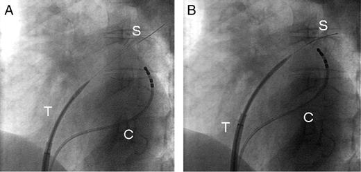 (A) This is a fluoroscopic image showing the transseptal sheath positioned on the fossa ovalis in a 30° left anterior oblique position without advancing the needle. The SafeSept™ wire is seen penetrating the interatrial septum and the TSGW is then passed into the left superior pulmonary vein. (B) The dilator portion of the sheath is then advanced over the TSGW, later followed by the outer transseptal sheath. S represents the TSGW (SafeSept™), T the transseptal sheath, and C the quadrapolar coronary sinus catheter used for land-marking.