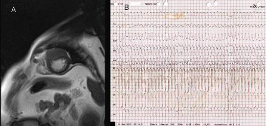 (A) Cardiac magnetic resonance showing a mass infiltrating the anterior−apical wall of the left ventricle. (B) Electrocardiogram showing sustained ventricular tachycardia with a rate of 260 bpm, QS from V1 to V6 and frontal right axis deviation.
