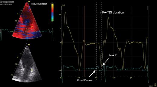Measurement of the total atrial conduction time (PA-TDI duration). A fixed 9 × 9 pixel region of interest (yellow) was positioned in the left atrial lateral wall on a tissue Doppler recording to obtain a tracing of the mechanical activation in this area (yellow tracing). A simultaneously acquired registration of surface electrocardiogram lead II (blue tracing) was displayed underneath the tissue Doppler tracing. The PA-TDI duration (double arrow) was assessed by measuring the time interval between the onset of the P-wave in lead II and the peak A’-wave on the tissue Doppler tracing (single arrows).