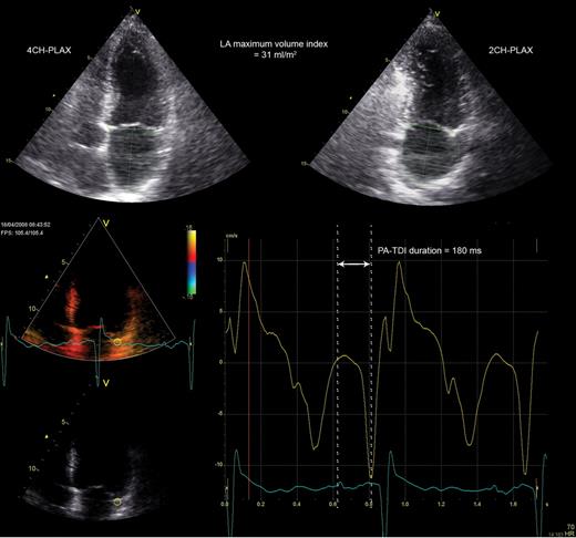 Example of a patient with a small left atrial size and a long total atrial conduction time (PA-TDI duration). The left atrial maximum volume index was obtained from the two- and four-chamber parasternal long-axis views (2CH-PLAX and 4CH-PLAX, respectively) and measured 31 mL/m2. A tissue Doppler tracing of the left atrial lateral wall demonstrated a PA-TDI duration (arrow) of 180 ms. Despite the small left atrial size, the long PA-TDI duration indicates a large extent of atrial remodelling. This patient has experienced recurrence of atrial fibrillation during follow-up.