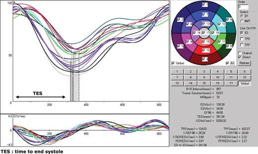 The main window of cardioGRAF® processing the electrocardiogram-gated myocardial perfusion single photon emission computed tomography (SPECT) in a healthy subject. The division of the left ventricular myocardium into 17 volume segments and numbering are illustrated on the upper right panel. The upper left panel displays the time–volume curves of the segments. The time 0 on the abscissa is triggered on the peak of the R-wave that is not shown here. The lower left panel shows the derivative of the time–volume curves that corresponds to the contraction velocity of the respective volume segment. The vertical dotted lines on the time–volume curves are the instant of end systole of each regional myocardial volume estimated by zero-crossing of contraction velocity and minimal volume.