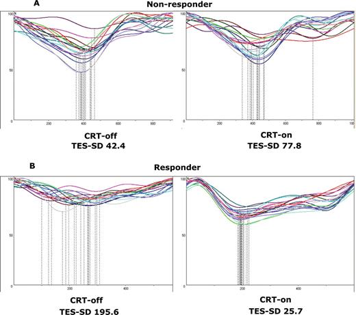 Changes in the time–volume curves derived by cardioGRAF® analyses between temporary cardiac resynchronization therapy suspension (CRT-off) and subsequent cardiac resynchronization therapy resumption (CRT-on) in a non-responder (A) or a responder (B) patient. Standard deviations of time to end systole of all 17 left ventricular segments (standard deviations of time to end systole) for non-responders at CRT-off and CRT-on were 42.4 and 77.8, respectively. Standard deviations of time to end systole for responders at CRT-off and CRT-on were 195.6 and 25.7, respectively.