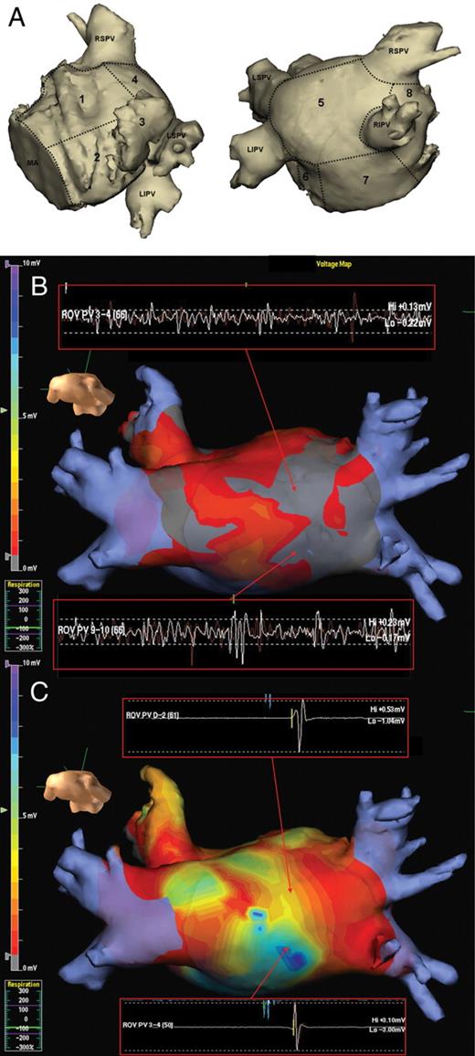 (A) Two views showing the eight left atrial segments used for regional analysis. 1, anterior; 2, lateral; 3, left atrial appendage; 4, roof; 5, posterior; 6, mitral isthmus; 7, floor; 8, septum; MA, mitral annulus; LSPV, left superior pulmonary vein; LIPV, left interior pulmonary vein; RSPV, right superior pulmonary vein; RIPV, right inferior pulmonary vein. (B and C) Colour-coded voltage map in the posterior–anterior view from the NavX 3D electroanatomic mapping system with areas of low voltage (<0.5 mV) in grey and normal voltage in remaining colour scale. Note increased areas of low voltage in AF (B) compared with normal voltages in paced rhythm (C). Note the regions of highly fractionated and low-voltage (<0.5 mV) signals during AF in (B) do not display fractionation and have a normal voltage in paced rhythm (C).