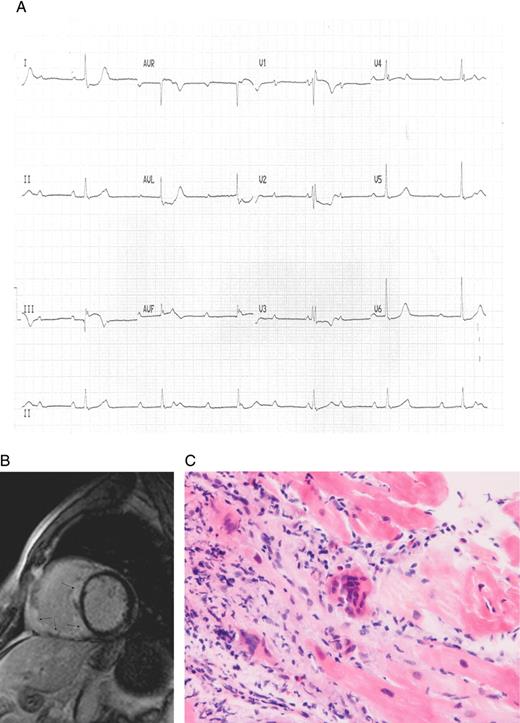(A) Resting electrocardiogram demonstrating heart block, right bundle branch block pattern, and ST elevation in limb leads III and aVF with ST depression in leads I, aVL, and V2. (B) Cardiac magnetic resonance imaging scan showing extensive myocardial infiltration affecting most of the right ventricle and interventricular septum with abnormal late gadolinium hyper-enhancement in these regions. (C) Histology from a cardiac biopsy taken from the right ventricular septum revealing a prominent mixed inflammatory infiltrate including macrophages, giant cells, lymphocytes (mostly T cells), and eosinophils consistent with giant cell myocarditis.